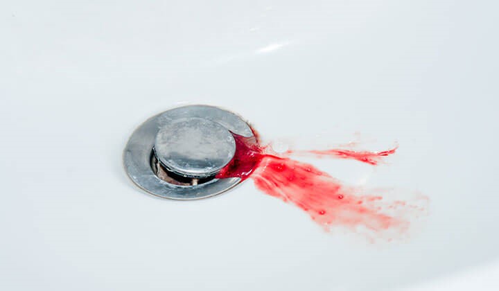 odtok s krvou Krvácanie ďasien môže mať rôzne príčiny