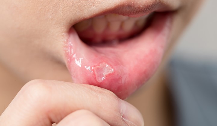 Druhy áft Druhy áft